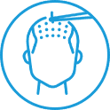Hair transplant procedure